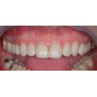 Emax veneers (fazety) 13-24